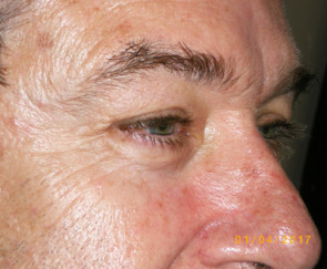 Male Eyelid Surgery