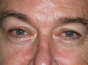 Patient 31 - After View 