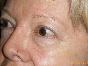 Female Eyelid Surgery