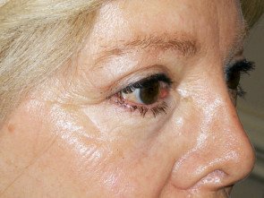 Female Eyelid Surgery