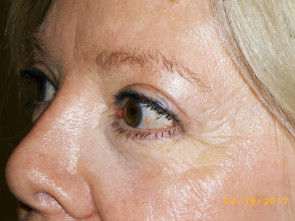 Female Eyelid Surgery