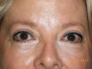 Female Eyelid Surgery