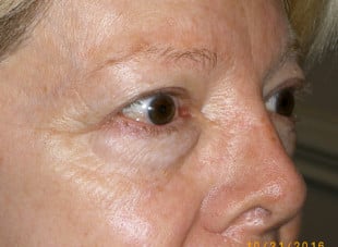 Patient 79 - Before View 