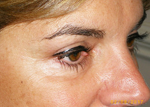 Female Eyelid Surgery