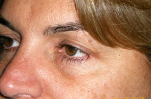 Female Eyelid Surgery