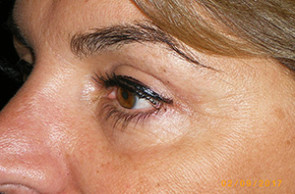 Female Eyelid Surgery