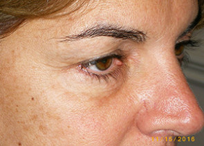 Female Eyelid Surgery