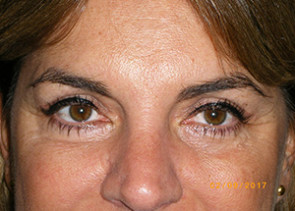 Female Eyelid Surgery