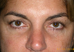 Female Eyelid Surgery