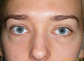 Female Eyelid Surgery