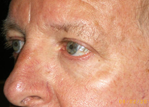 Male Eyelid Surgery