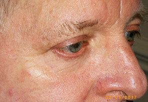 Male Eyelid Surgery