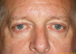 Male Eyelid Surgery