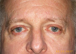 Male Eyelid Surgery