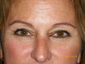 Female Eyelid Surgery