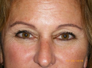 Patient 57 - Before View 