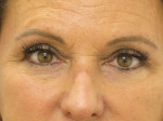 Female Eyelid Surgery