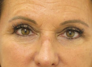 Patient 57 - After View 