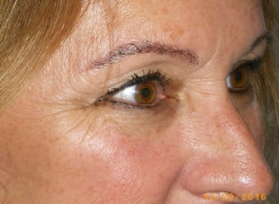 Patient 57 - Before View 