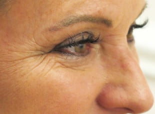 Patient 57 - After View 