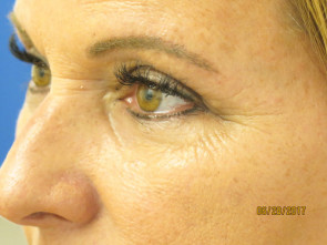 Female Eyelid Surgery