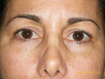 Female Eyelid Surgery