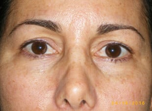 Patient 65 - Before View 