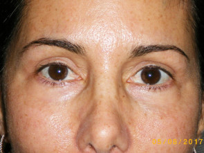 Female Eyelid Surgery