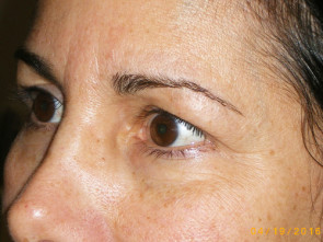 Female Eyelid Surgery