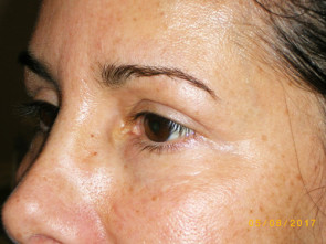 Female Eyelid Surgery