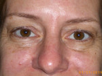 Female Eyelid Surgery