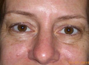 Patient 62 - Before View 