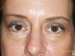 Female Eyelid Surgery