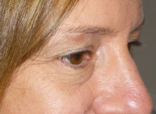 Patient 62 - Before View 