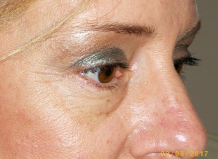 Patient 62 - After View 