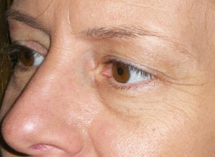 Patient 62 - Before View 