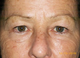 Patient 53 - Before View 