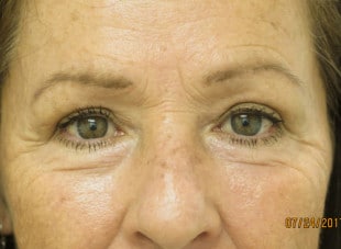 Patient 53 - After View 