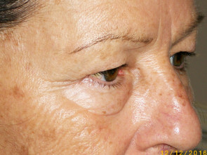 Female Eyelid Surgery