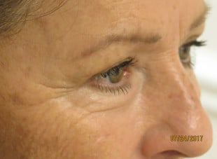 Patient 53 - After View 