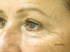 Female Eyelid Surgery