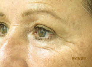 Patient 53 - After View 