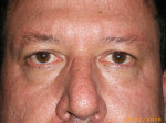 Male Eyelid Surgery