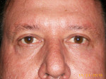 Male Eyelid Surgery