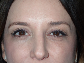 Ptosis Surgery with Blepharoplasty