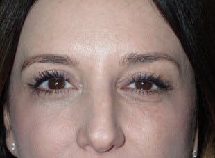 Patient 14 - Before View 