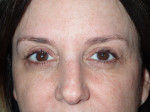 Ptosis Surgery with Blepharoplasty