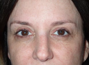 Patient 14 - After View 