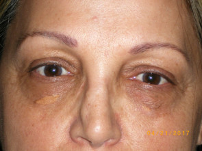 Female Eyelid Surgery