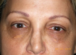 Patient 13 - Before View 